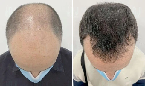 Antes y después