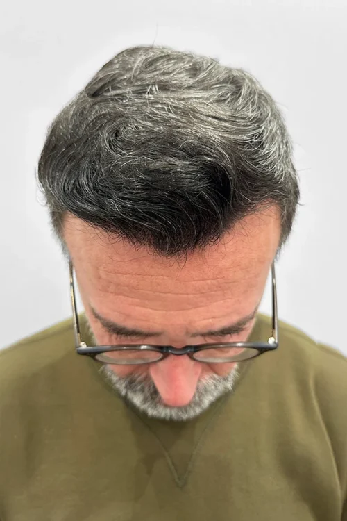 Después de la Cirugía Capilar